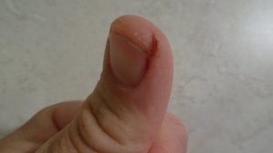 Rissige Finger auf einer Höhenexpedition - Aconcagua 2016
